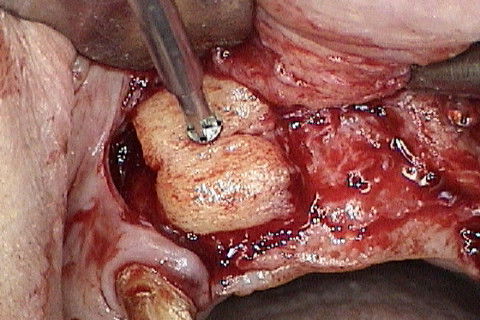 Abertura do retalho e inicio da remoção dos parafusos de osteossíntese na região 12