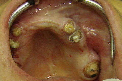 Vista oclusal da região 25 e 26