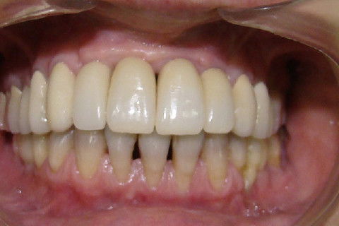 Finalização do tratamento reabilitador, com coroas metalo-ceramicas superiores e coroas unidas no lado direito da mandibula e unitaria da lado esquerdo