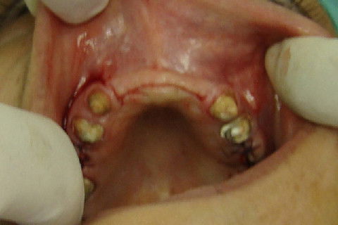 Incisões horizontais e verticais para expor os implantes
