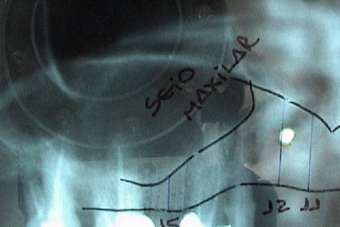 Visáo aproximada da região a ser feita elevação do soalho do seio maxilar