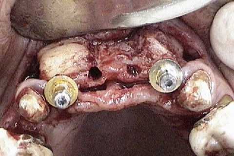 Colocação dos implantes nas regiões 12 e 22 e perfuração das regiões 11 e 21