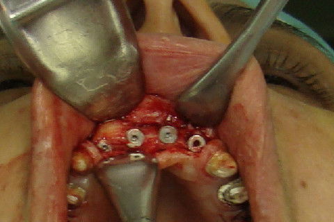 Rebatimento do retalho e exposição dos implantes