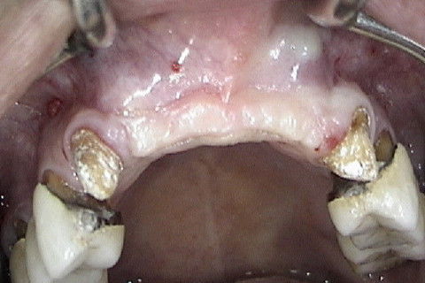 Aspecto clinico da região anterior da maxila 6 meses após o enxerto