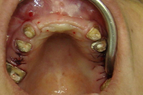 Vista oclusal da região anterior da maxila, antes da reabertura