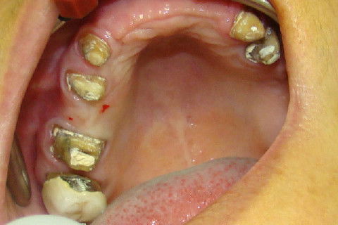 Abertura das regiões de seio maxilar e reabertura dos implantes da região anterior da maxila