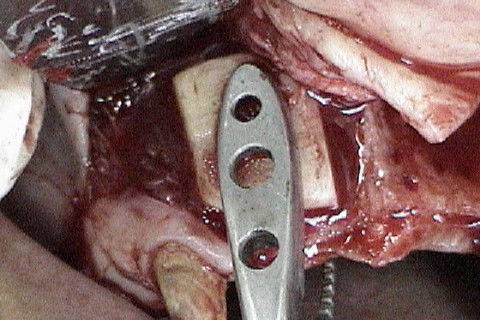 Bloco ósseo sendo fixado com o auxilio de pinça porta-enxerto