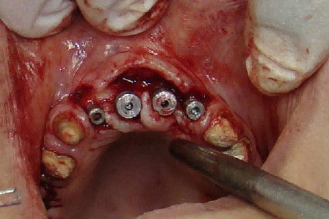 Recortes de pequenos pediculos que serão dobrados no sentido interproximal no intuito de formar papilas interimplantares