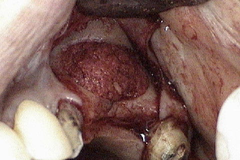 Preenchimento total do espaço criado com a elevação do soalho do seio maxilar