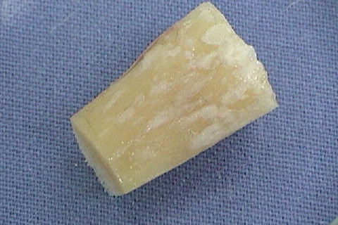 Bloco ósseo cortico-medular