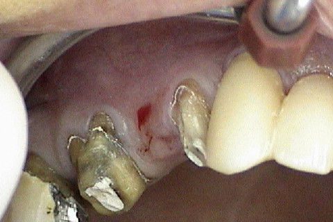 Região do dente 15, onde será feita elevação do soalho do seio maxilar