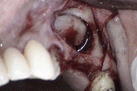 Rebatimento da janela óssea , para dentro e para o alto, semelhante ao movimento de porta de garagem.