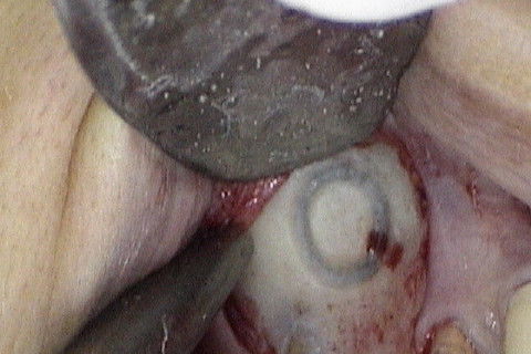 Rebatimento do retalho e janela óssea confeccionada com ponta diamantada esferica n. 6, em peça de mão reta