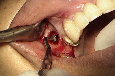 Enxerto sendo condensado, preenchendo todos os espaços existentes com a elevação da membrana de Schneider