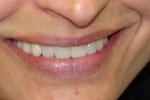 Sorriso final da paciente