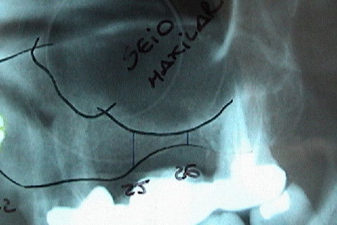Visão aproximada da área dos dentes 25 e 26, para elevação do soalho do seio maxilar