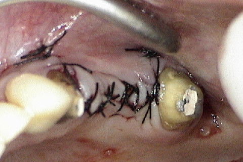 Sutura da região enxertada