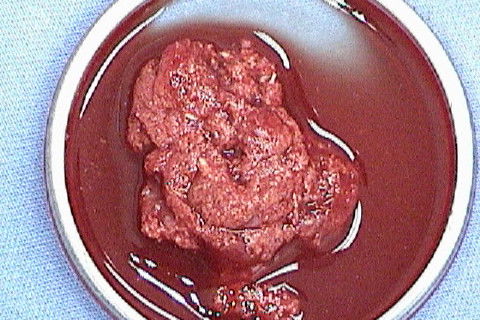 Aspecto do enxerto mesclado ao PRP