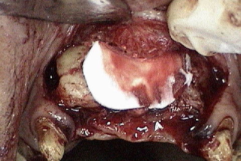 Preenchimento dos espaços existentes com osso particulado e proteção com membrana de colageno