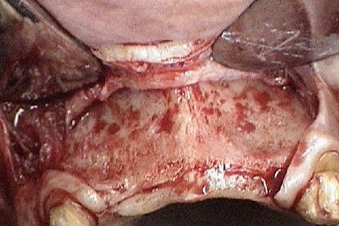 Mostrando o defeito ósseo após rebatimento do retalho