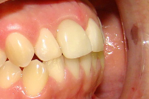 Vista mais aproximada dos contornos gengivais