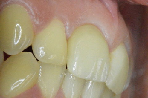 Retorno após 9 meses da colocação de coroa metalo-ceramica parafusada