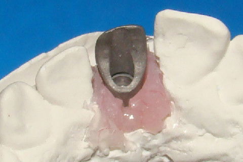 Vista palatine do coping