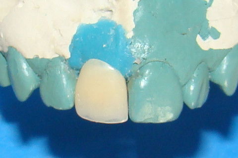 Vista vestibular da coroa temporária, que dará o format ideal dos tecidos gengivais