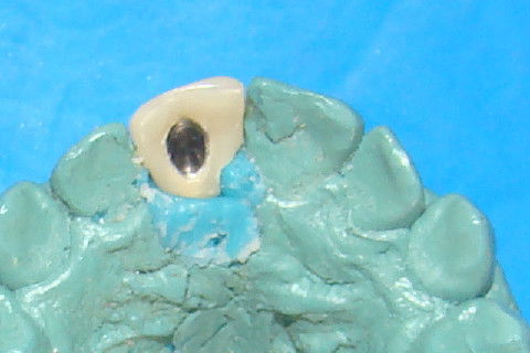 Vista palatine da coroa temporária