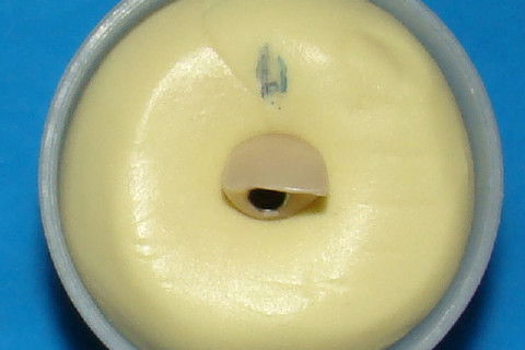 Coroa temporária presa ao analogo do implante, incluida no material pesado de moldagem