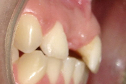 Vista da depressão gingival vestibular na região do implante a ser reaberto
