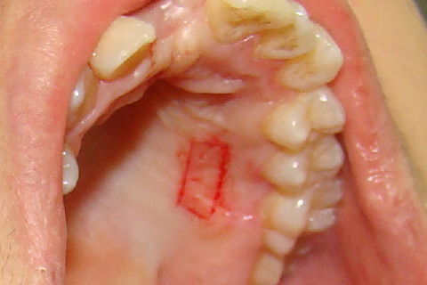 Marcação do tecido a ser removido