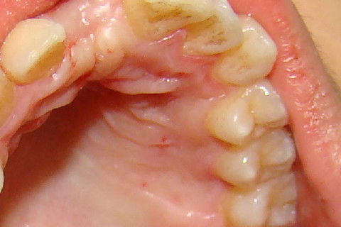 Região palatina, onde será removido o enxerto gingival.