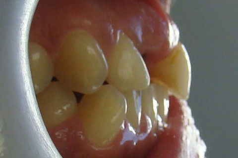 Foto de perfil, mostrando a melhora no contorno dos tecidos gengivais