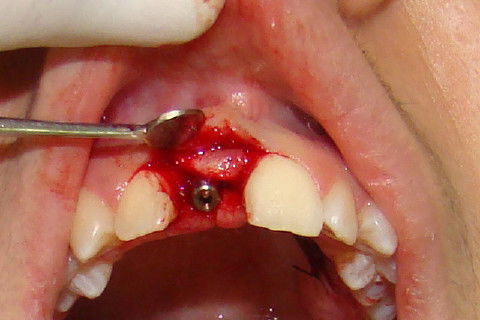 Colocação do enxerto gengival