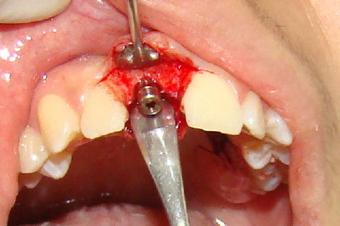 Exposição do implante, colocação de cicatrizador, antes da colocação do enxerto