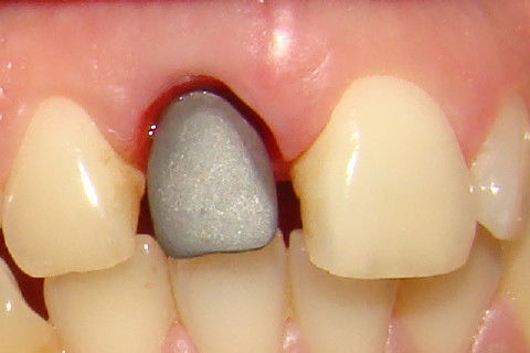 Aspecto do coping no dia da prova