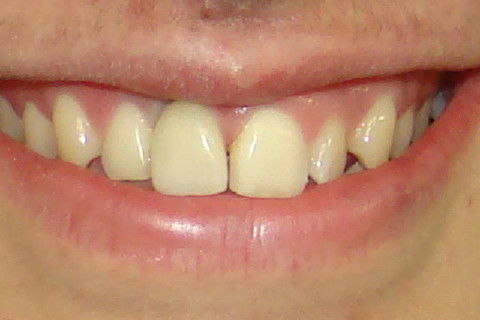 Sorriso da paciente no dia da colocação da coroa