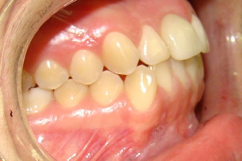 Contornos gengivais compatíveis com os dentes adjacentes