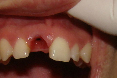 Aspecto dos tecidos gengivais na dia da remoção da coroa temporária e personalização do transferente.