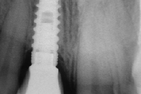 Controle radiográfico