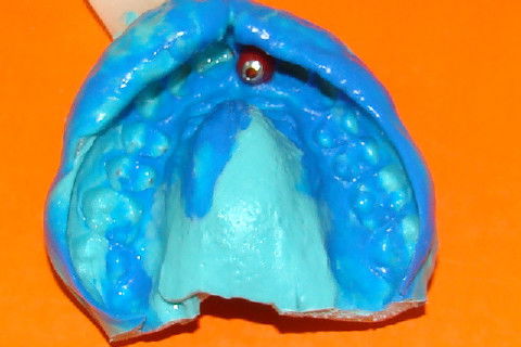 Moldagem com transfer longo personalizado