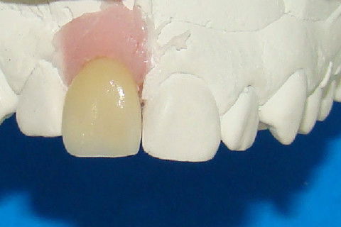 Aspecto vestibular da coroa metalo-cerâmica no modelo