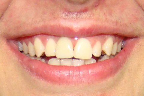 Aspecto do sorriso após colocação de resina composta na mesial do element 21 afim de deixar os centrais com a mesma largura