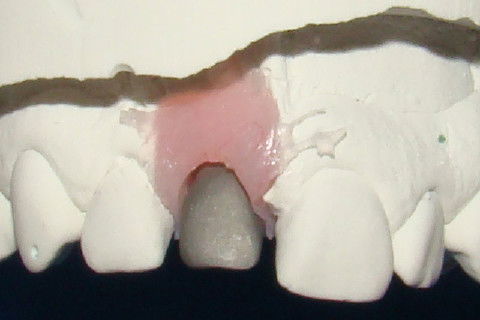 Coping para coroa metalo-ceramica no modelo