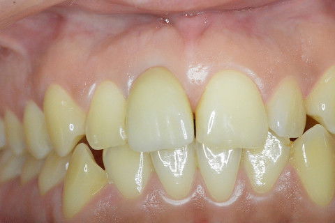 Retorno após 9 meses da instalação de coroa metalo-ceramica parafusada