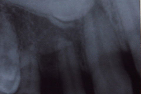 RX periapical do elemento.