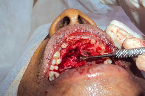 Área após remoção dental