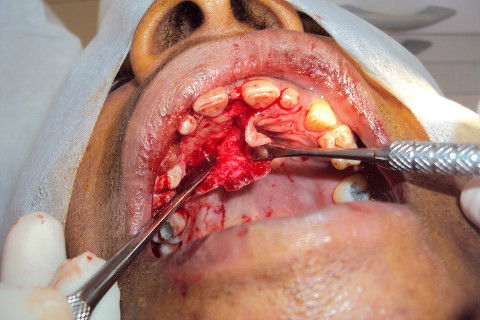 esposição do descolamento