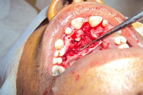 Ostectomia expondo o elemento dental